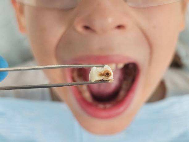 Best Urgent Tooth Repair  in Mack, OH